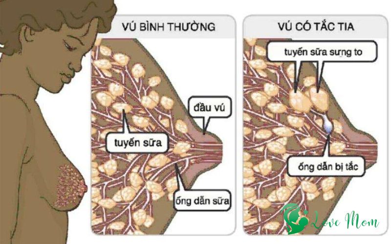 Sua-tich-tu-lau-dai-khong-duoc-xu-ly-gay-viem-nhiem