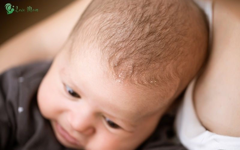 Cach-dieu-tri-viem-da-tiet-ba-o-tre-so-sinh