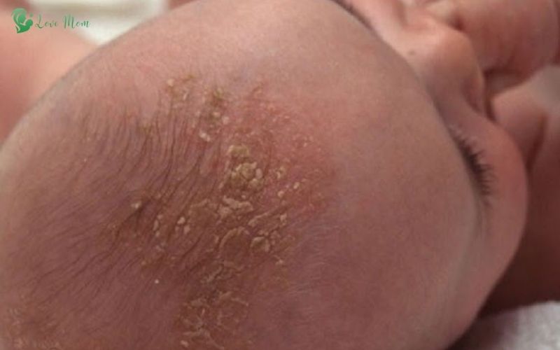 Nguyen-nhan-gay-viem-da-tiet-ba-o-tre-so-sinh